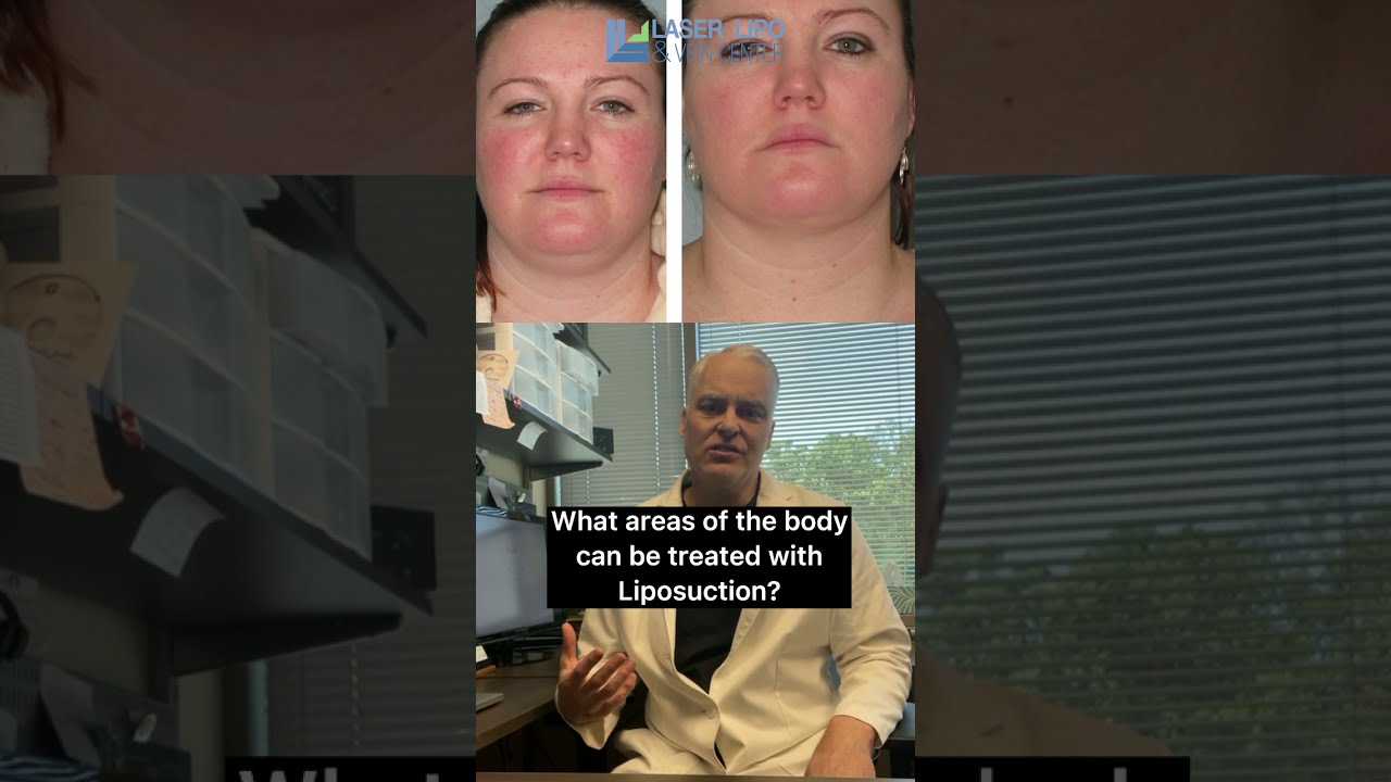 What Areas Of The Body Can Be Treated With Liposuction 