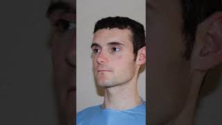 Sekonder Rhinoplasty U0026  Bichectomy bichectomia rhinoplasty malerhinoplasty malebichectomy