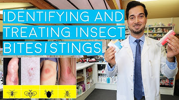 Insect Bites and Stings | Insect Bites Treatment | How to Treat Insect Bites and Stings | 2018