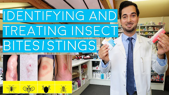 Insect Bites and Stings | Insect Bites Treatment | How to Treat Insect Bites and Stings | 2018 - DayDayNews