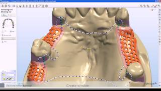 Removable Partial Design
