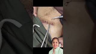 Appendix Removal #shorts #youtubeshorts #nurse #nursing #healthtips #medical #hospital #injection