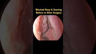 Chronic nose block &amp; snoring: Before-and-after surgery view