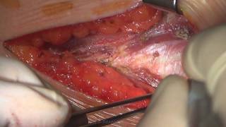 Остеосинтез Ребра При Переломе Со Смещением Рнцх