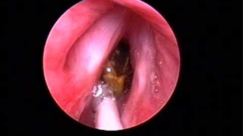 Foreign bodies in airway - Stanford Children