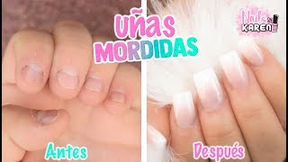 Bitten Nails | Nail Biting: Total Change!