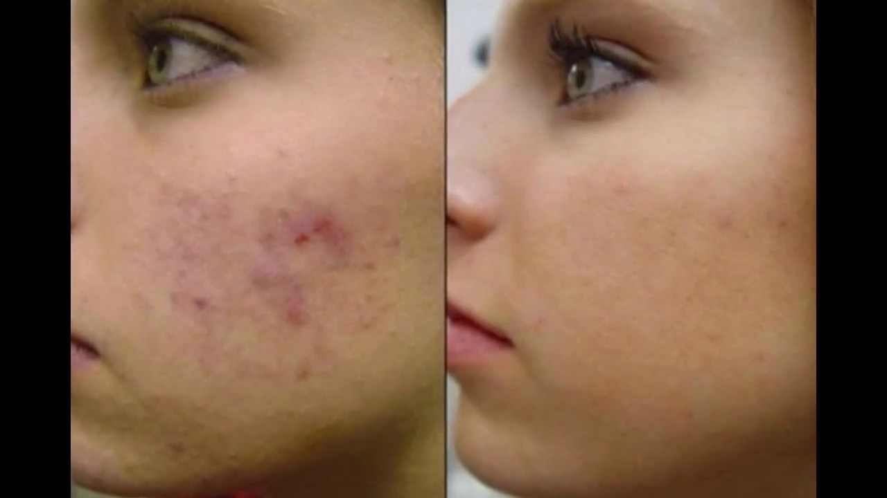 Como Quitar el Acne y Las Cicatrices de La Cara