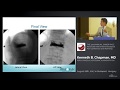 Vertebroplasty and Kyphoplasty Lecture Dr. Chapman