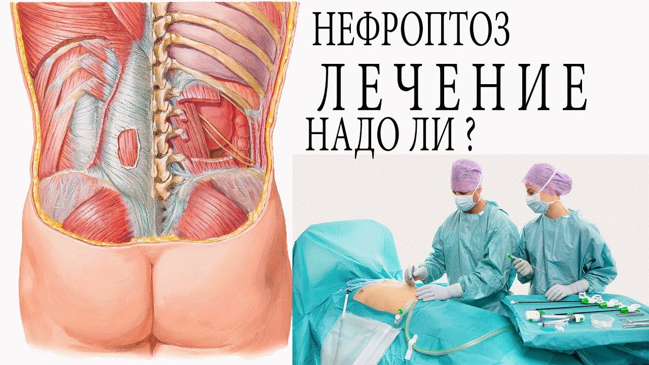Как лечить нефропоз [опущение почки] - YouTube