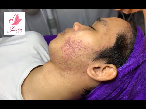 Relax video : Squeeze acne on the face!