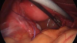Early Ovarian Torsion Laparoscopic Management التواء المبيض و العلاج بالمنظار الجراحي- دلؤي أبوعتيله