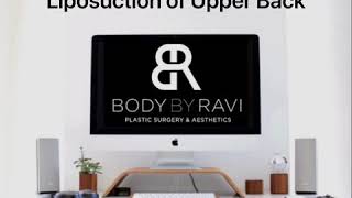 Removing Upper Back And Bra Roll Fat With Vaser Isted Power Liposuction