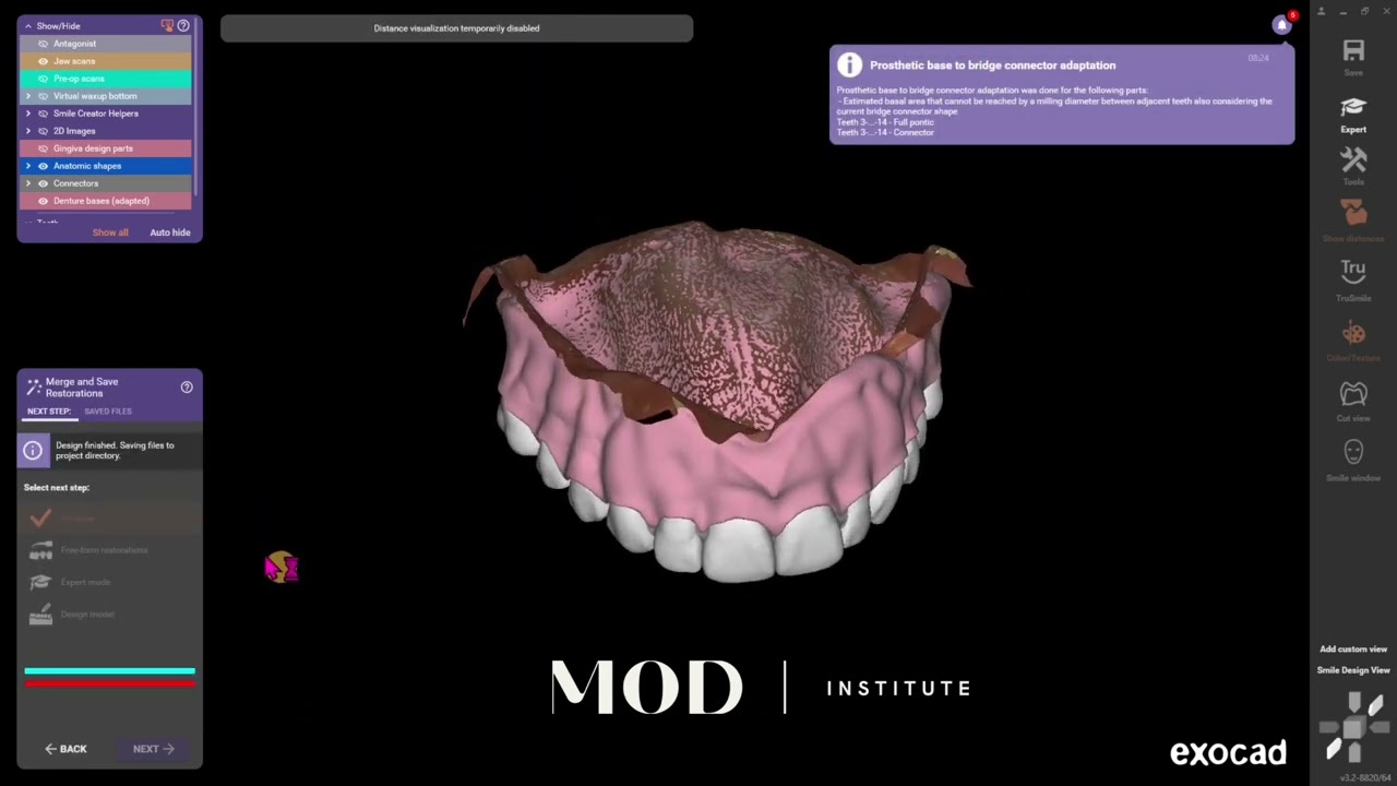How to rebase a denture in exocad in under 5 minutes