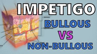 IMPETIGO EXPLAINED IN 2 MINUTES - BULLOUS vs NON-BULLOUS IMPETIGO