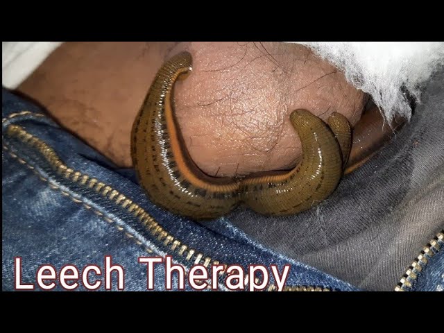 Leech Therapy for Varicocele, Erectile Dysfunction at Deevya Ayurveda and Panchkarma Center