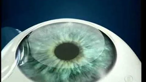 Tem cirurgia para o astigmatismo?