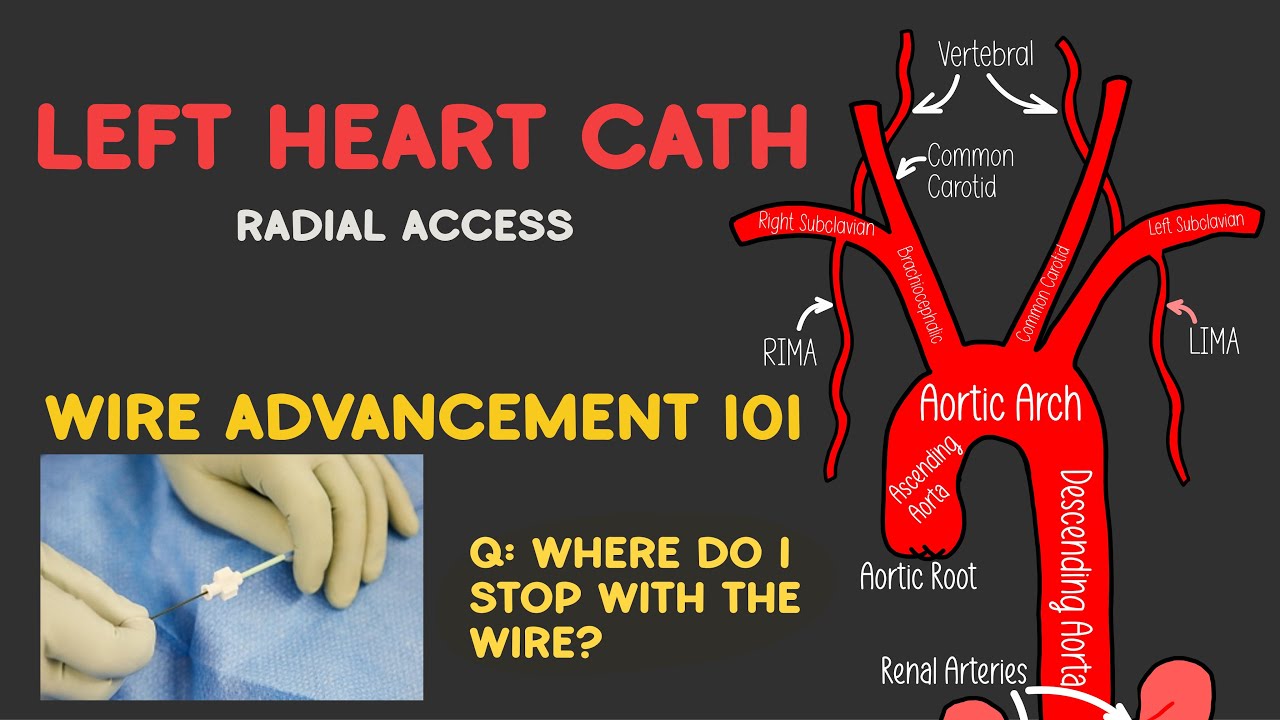 Советы по катетеризации левого сердца (WIRE)! Где остановиться?