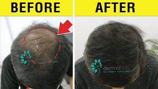 Dermaroller Hair Growth में काम कैसे करता है (HINDI) || Dermaroller for Hair Growth in Hindi