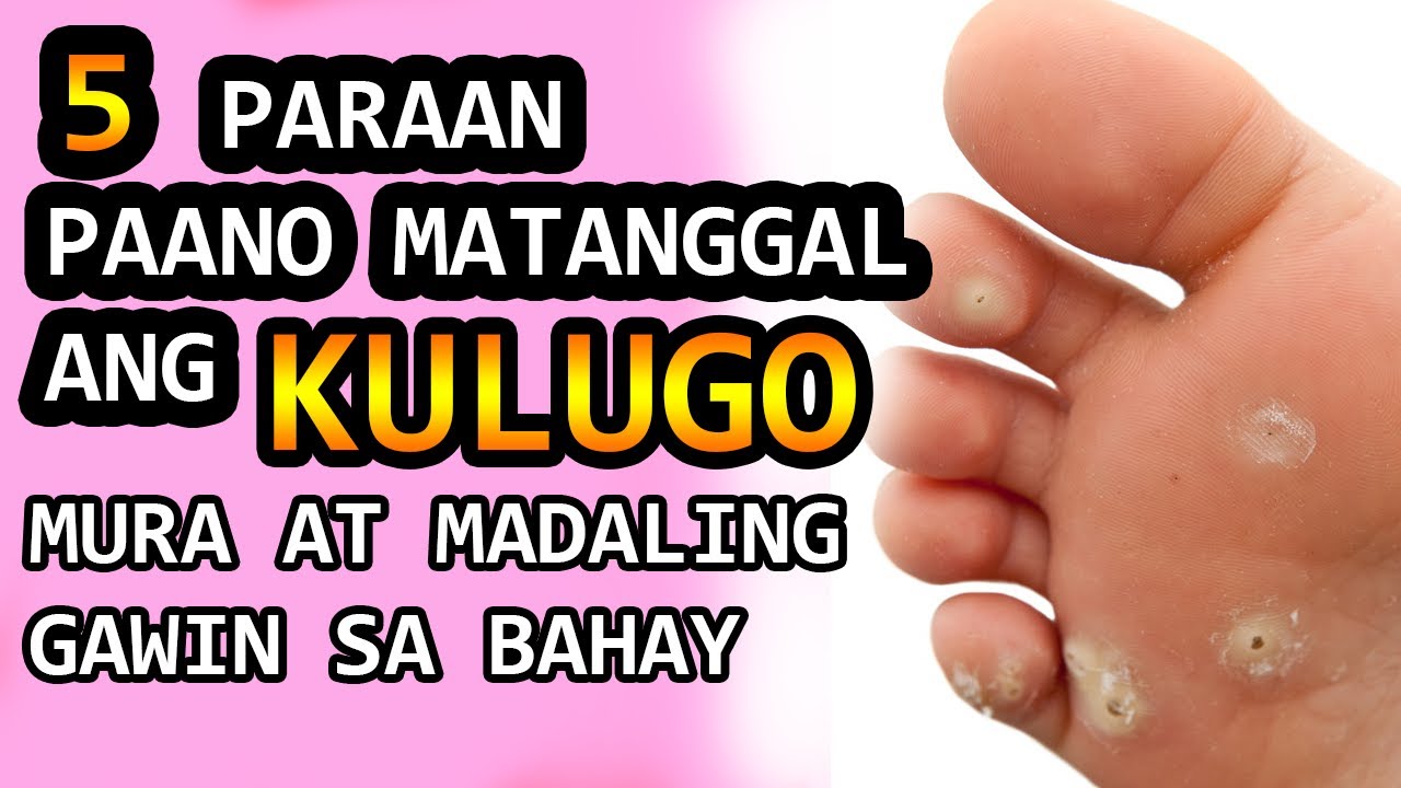 Paano Tanggalin Ang Kulugo O Warts In Just Or Days Gamot Sa | My XXX