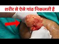 Multiple lipoma cure  huge lipoma removal