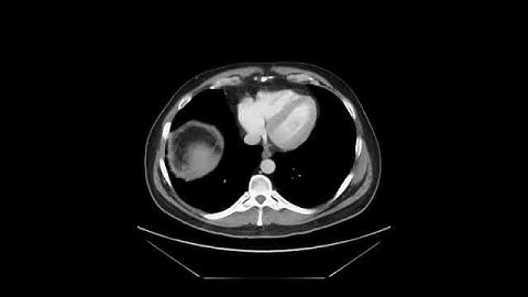 C. difficil Pseudomembranous colitis - axial CT