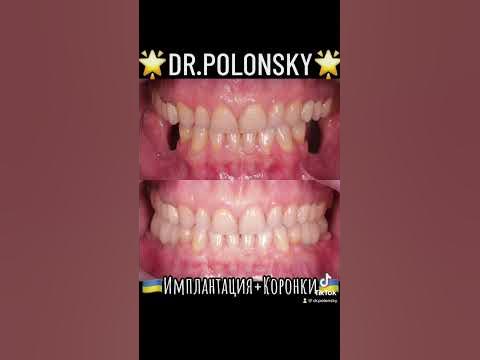 Стоматолог Одесса Доктор Полонский Стоматологія Одеса Вініри #Одеса # ...