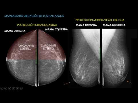 Vídeo: Imágenes De Mamografía: Comprender Sus Resultados