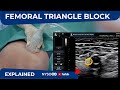 Ultrasound-Guided Femoral Triangle Nerve Block - NYSORA's Regional Anesthesia Clinical cases