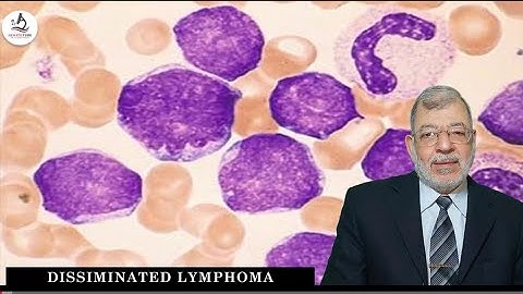 09 Diffuse large B cell Lymphoma part 1