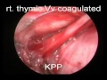 Thymectomy dr ketan parikh