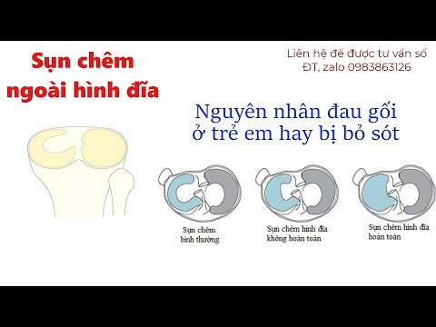 Video NỘI SOI GỌT SỤN CHÊM NGOÀI HÌNH ĐĨA BỊ RÁCH KIỂU QUAI... - youtube