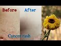 Calendula Infused Oil for Skin Cancer Rash. Radiotherapy Side Effect. Skin Rash Natural Remedy