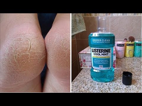 Video: Amazing Ways Every Woman Should Know About Listerine Uses