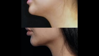 FaceTite Buccal Fat Pad Resection Lipo Facial Contouring V line [UPDATED 3 year followup]
