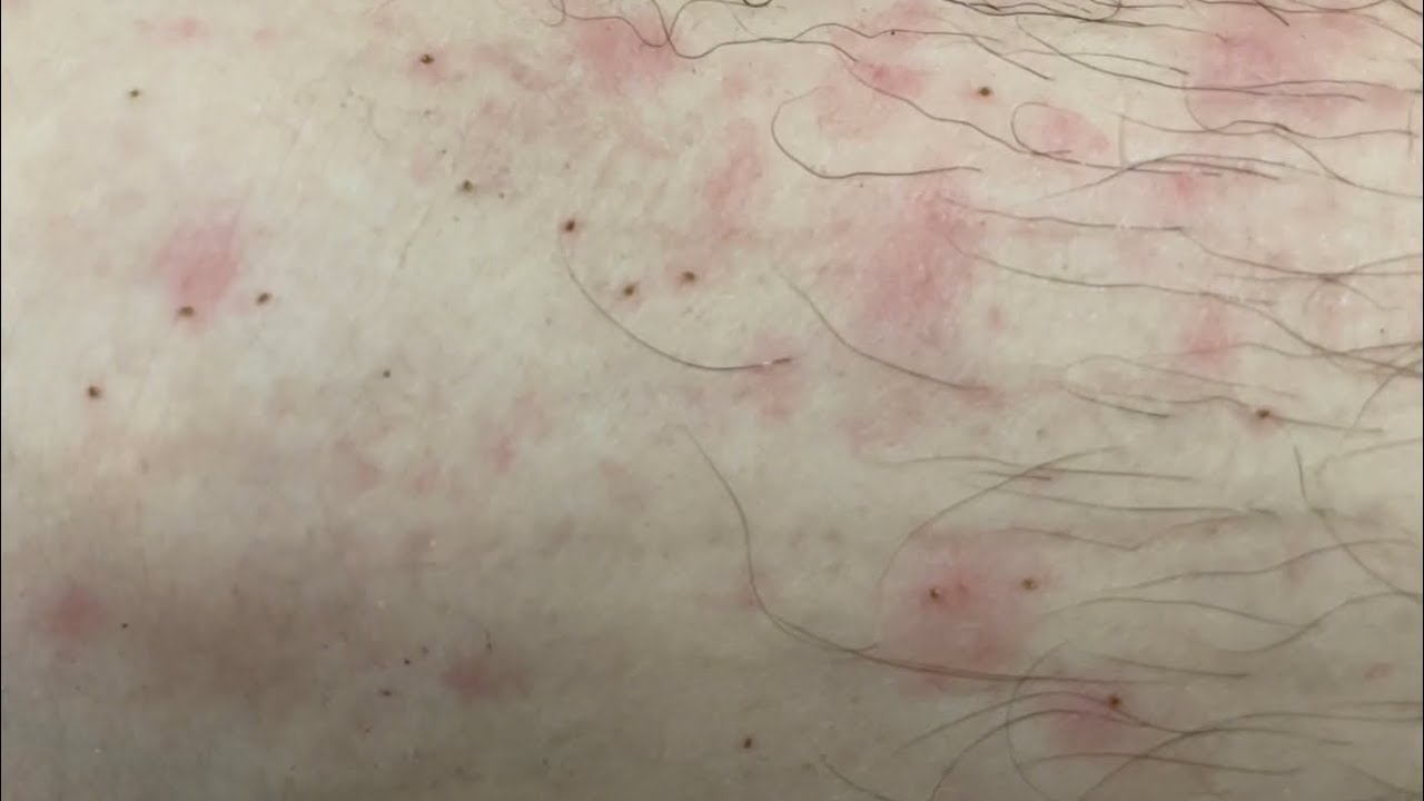 100 tiny ticks youtube