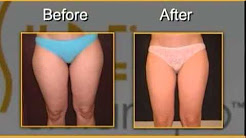 Smartlipo Liposuction Panama City