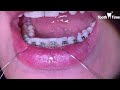 Hybrid orthodontic treatment Video # 2 Braces &amp; Clear Aligners together - Tooth Time Family Braces