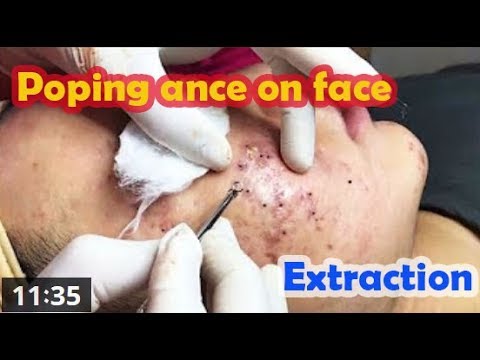 Worst Cystic Acne, Zits, Pimples, Blackheads and Whiteheads Extraction, Adult Facial Treatment, 