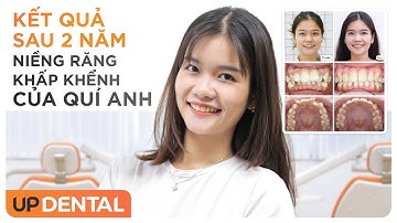 Kết quả sau 2 năm niềng răng khấp khểnh của Quí Anh