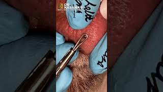 Old Blackheads Removal - NOSE