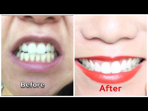 Teeth Whitening At Home - Before &amp; After - YouTube