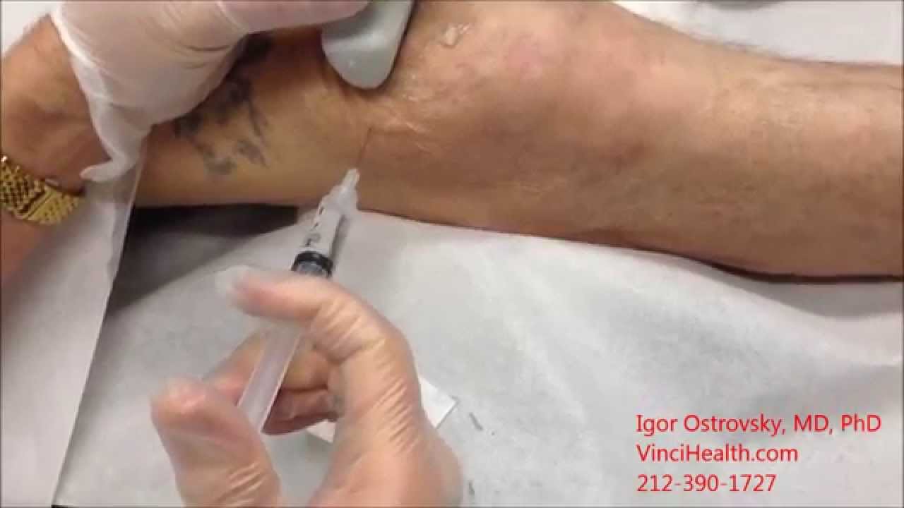 Prolotherapy for Osteoarthritis of the Knee Joint in NYC YouTube