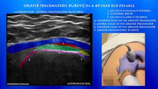 Ultrasound Of Greater Trochanteric Bursitis And Gluteal Tendons By Probeultrasound