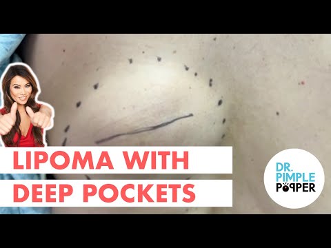 Lipoma with Deep Pockets