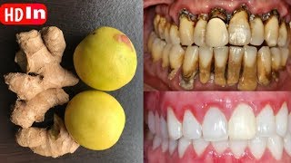 هذه الوصفة سطع الأسنان القذرة الصفراء مثل الحليب واللؤلؤ في دقيقتين.  علاج الأسنان البيضاء