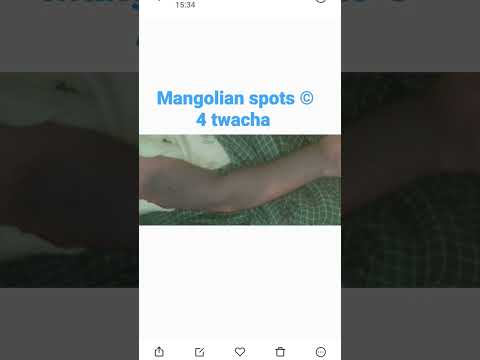 8-Mongolian spots# infants