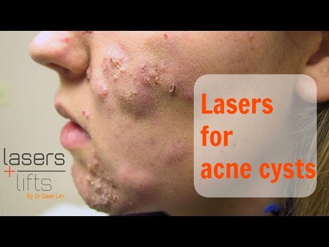 Treating acne cysts