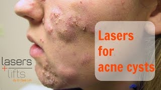 Treating acne cysts