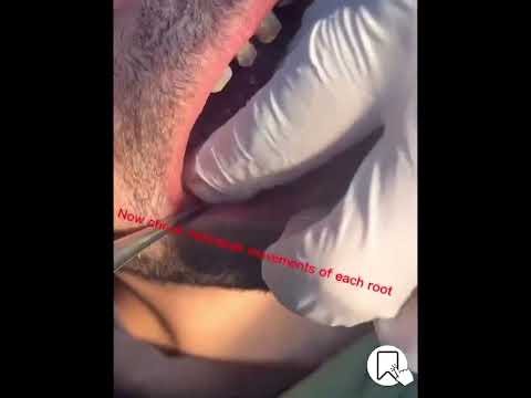 خلع ضرس سفلي مع فصل جذور د عمر ناجي البرنس Extraction With Separation