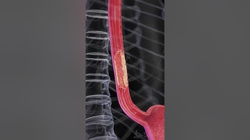⚠️ Esophageal Cancer: The Silent Threat ⚠️  #anatomy #medicalanimation